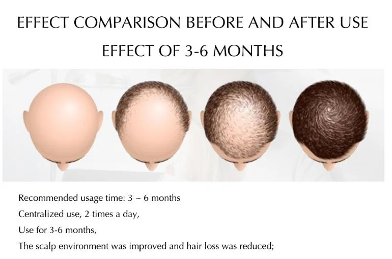5% Minoxidil Solution Anti Hair Loss CAS 38304-91-5
