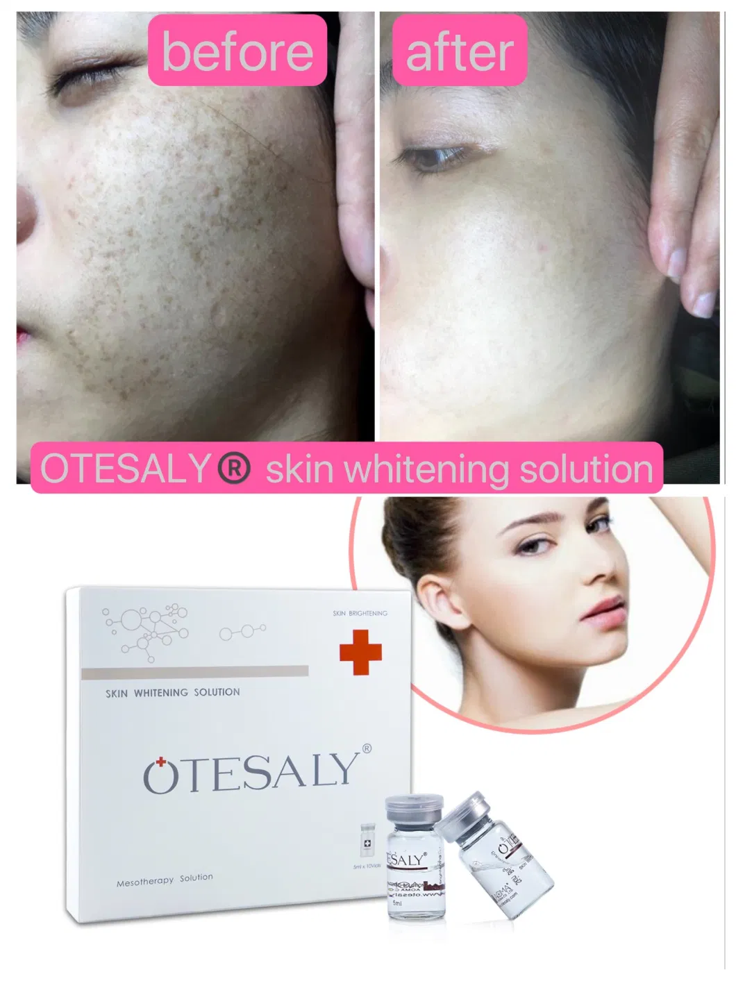 Otesaly Injectable Whitening Product Injection Mesotherapy and Anti-Wrinkle Whitening Liquid